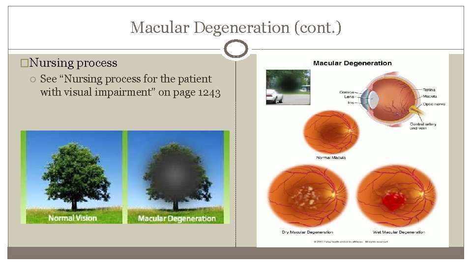 Macular Degeneration (cont. ) �Nursing process See “Nursing process for the patient with visual