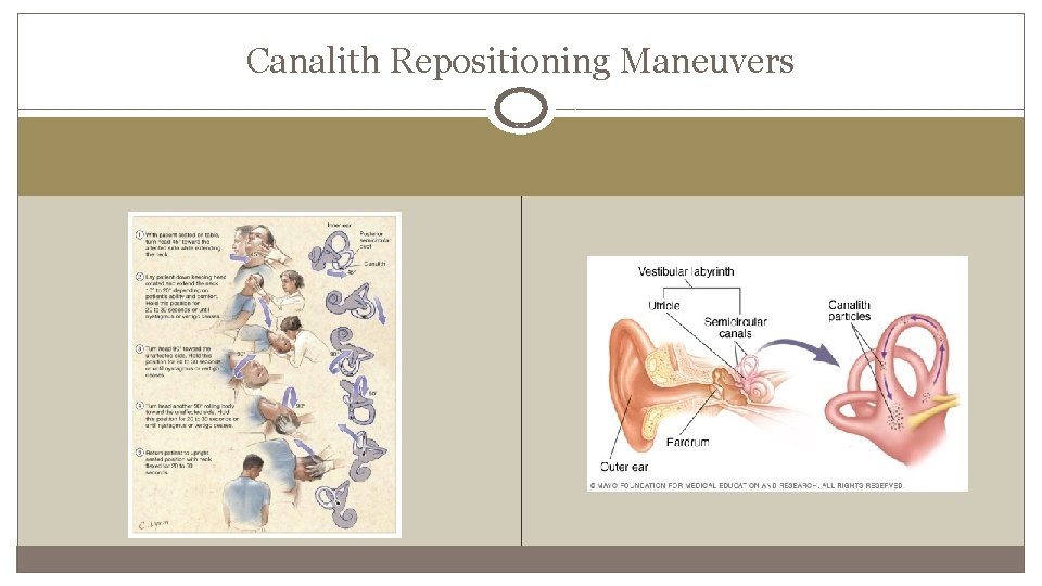 Canalith Repositioning Maneuvers 