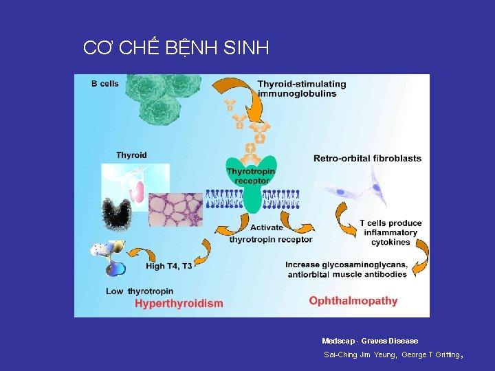 CƠ CHẾ BỆNH SINH Medscap - Graves Disease , Sai-Ching Jim Yeung, George T