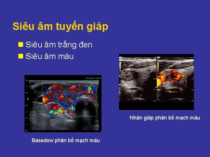Siêu âm tuyến giáp n Siêu âm trắng đen n Siêu âm màu Nhân