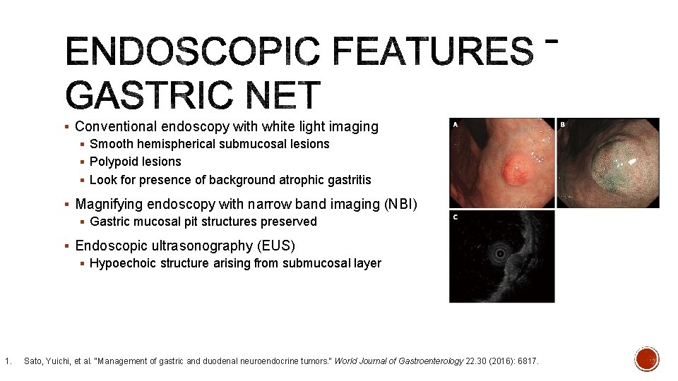 § Conventional endoscopy with white light imaging § Smooth hemispherical submucosal lesions § Polypoid