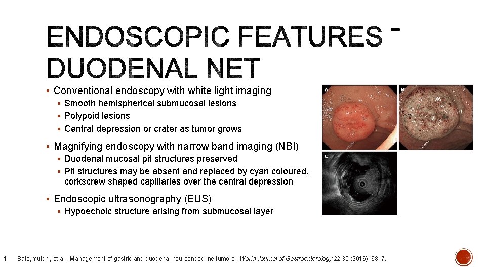 § Conventional endoscopy with white light imaging § Smooth hemispherical submucosal lesions § Polypoid