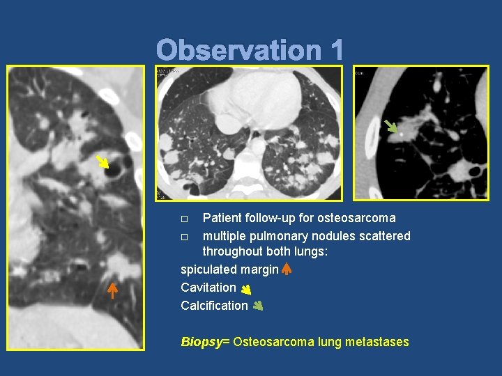 Observation 1 Patient follow-up for osteosarcoma multiple pulmonary nodules scattered throughout both lungs: spiculated