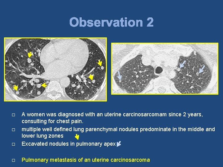 Observation 2 A women was diagnosed with an uterine carcinosarcomam since 2 years, consulting