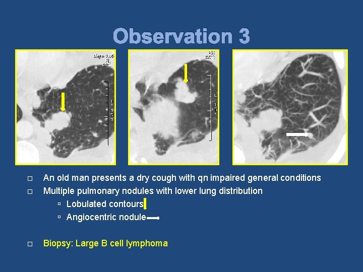 Observation 3 An old man presents a dry cough with qn impaired general conditions
