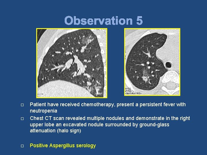 Observation 5 Patient have received chemotherapy, present a persistent fever with neutropenia Chest CT
