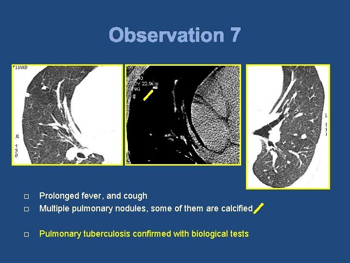 Observation 7 Prolonged fever, and cough Multiple pulmonary nodules, some of them are calcified