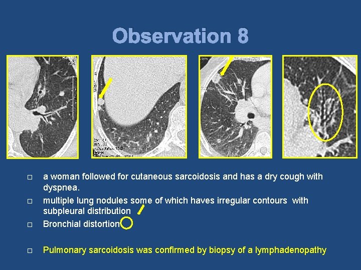 Observation 8 a woman followed for cutaneous sarcoidosis and has a dry cough with
