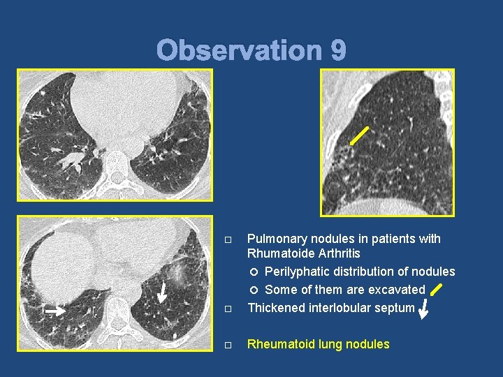 Observation 9 Pulmonary nodules in patients with Rhumatoide Arthritis Perilyphatic distribution of nodules Some