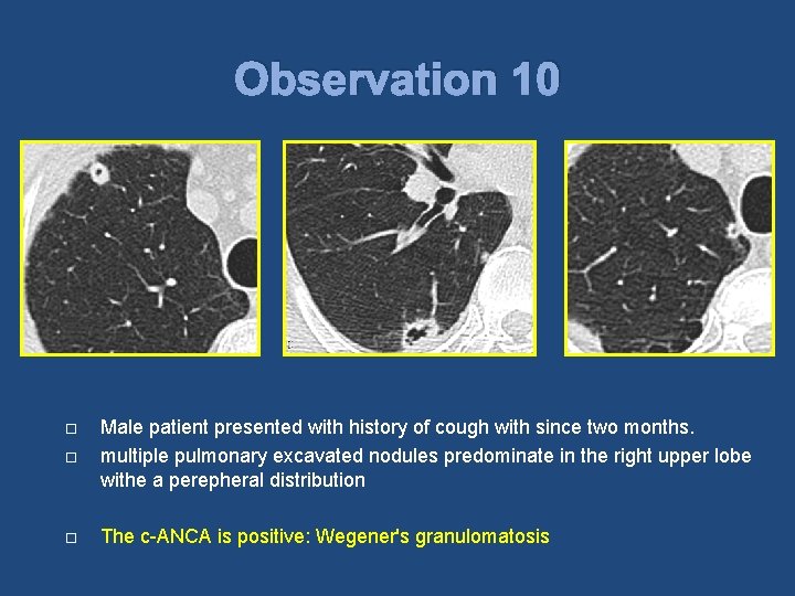 Observation 10 Male patient presented with history of cough with since two months. multiple