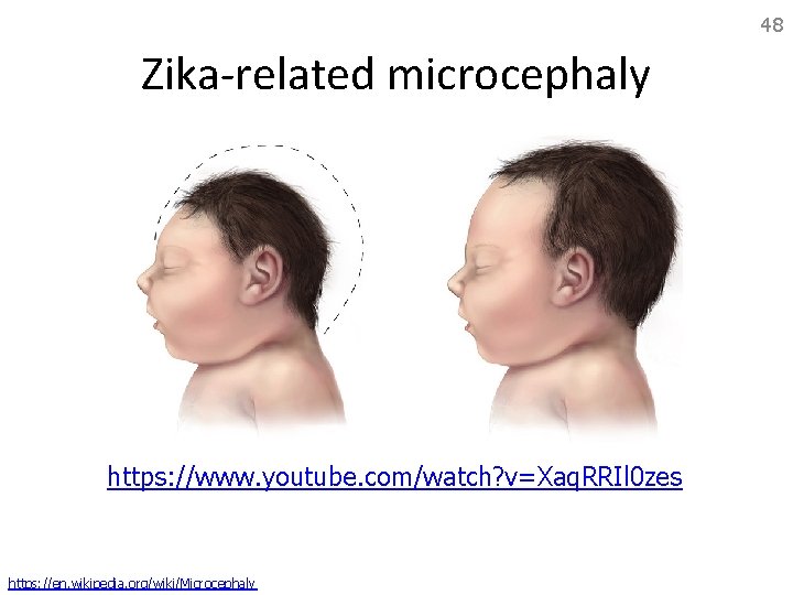 48 Zika-related microcephaly https: //www. youtube. com/watch? v=Xaq. RRIl 0 zes https: //en. wikipedia.