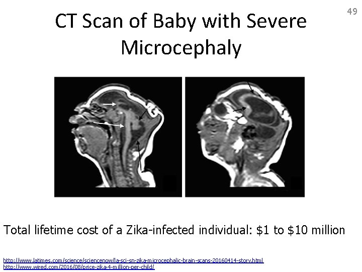 CT Scan of Baby with Severe Microcephaly Total lifetime cost of a Zika-infected individual: