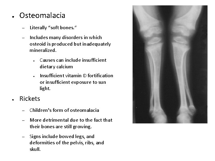 ● Osteomalacia – Literally “soft bones. ” – Includes many disorders in which osteoid
