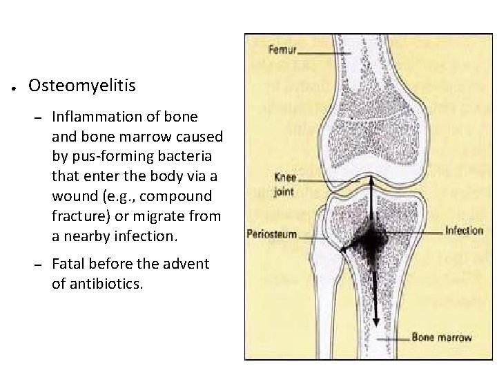 ● Osteomyelitis – Inflammation of bone and bone marrow caused by pus-forming bacteria that