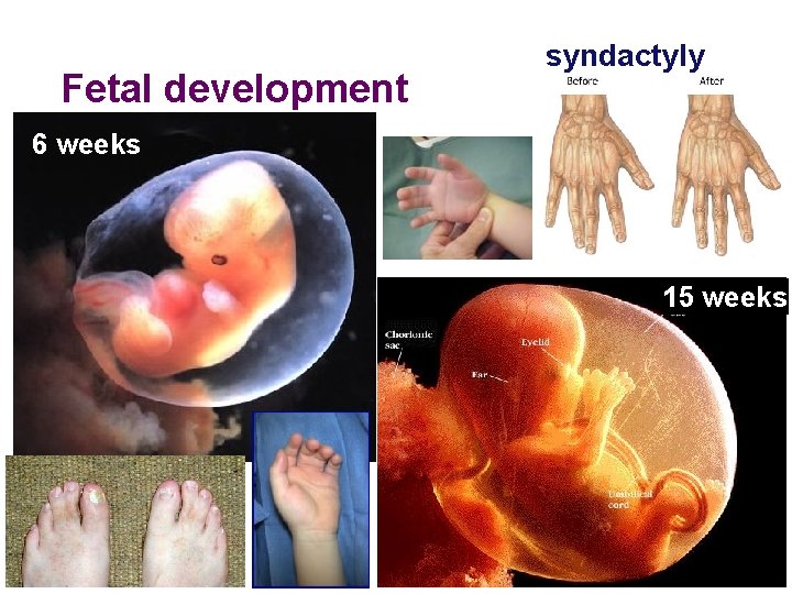 Fetal development syndactyly 6 weeks 15 weeks 