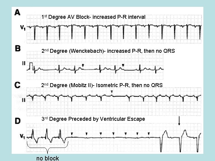 1 st Degree AV Block- increased P-R interval 2 nd Degree (Wenckebach)- increased P-R,