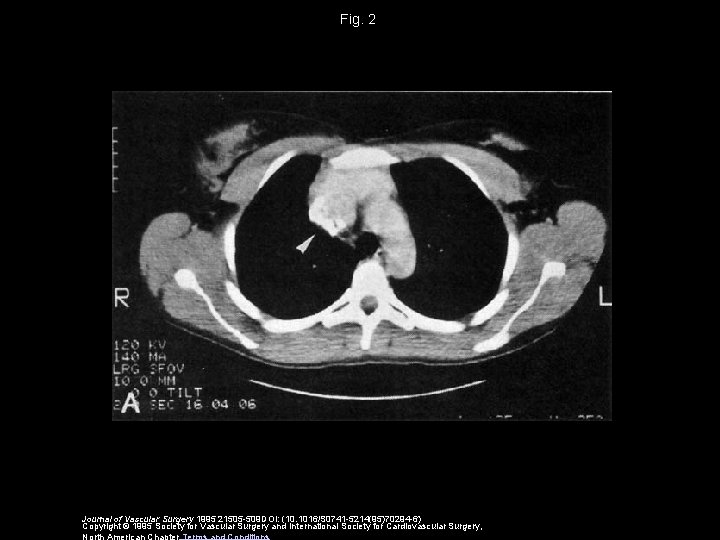 Fig. 2 Journal of Vascular Surgery 1995 21505 -509 DOI: (10. 1016/S 0741 -5214(95)70294