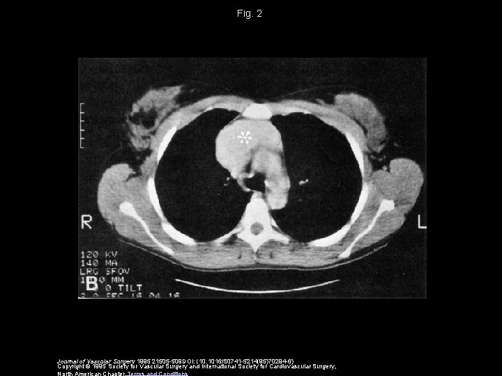 Fig. 2 Journal of Vascular Surgery 1995 21505 -509 DOI: (10. 1016/S 0741 -5214(95)70294