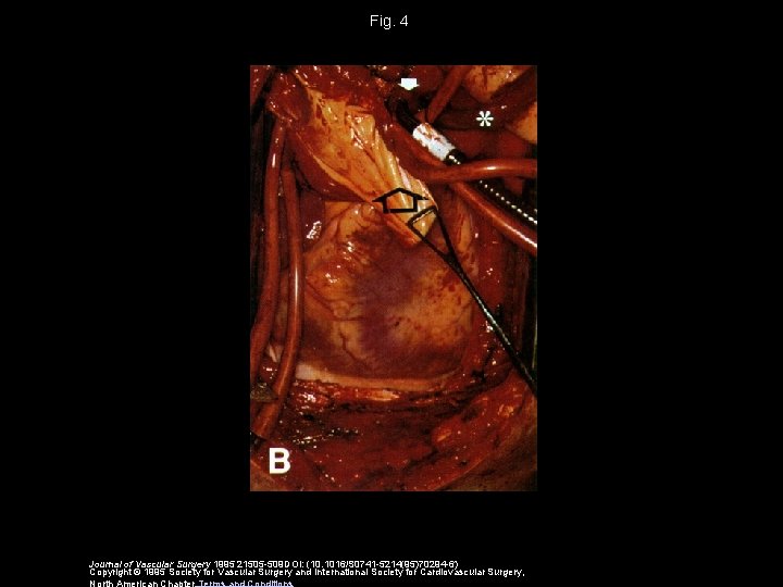 Fig. 4 Journal of Vascular Surgery 1995 21505 -509 DOI: (10. 1016/S 0741 -5214(95)70294