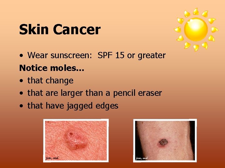 Skin Cancer • Wear sunscreen: SPF 15 or greater Notice moles… • that change
