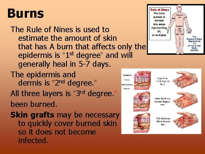 Burns The Rule of Nines is used to estimate the amount of skin that