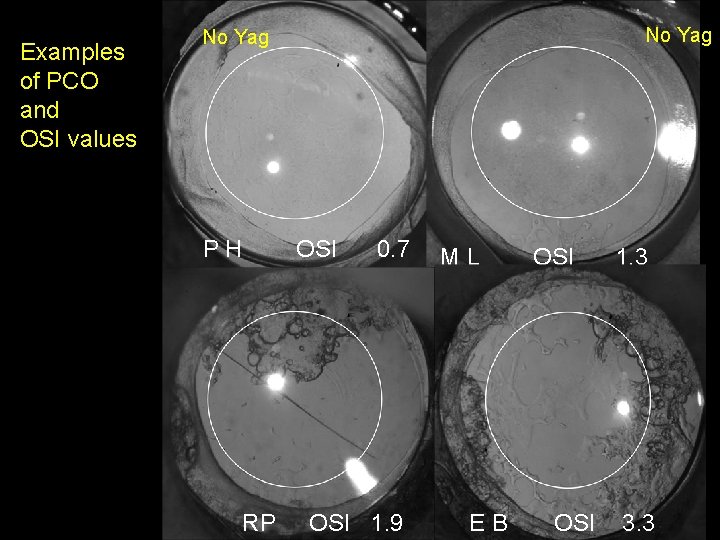 Examples of PCO and OSI values No Yag PH RP OSI 0. 7 OSI