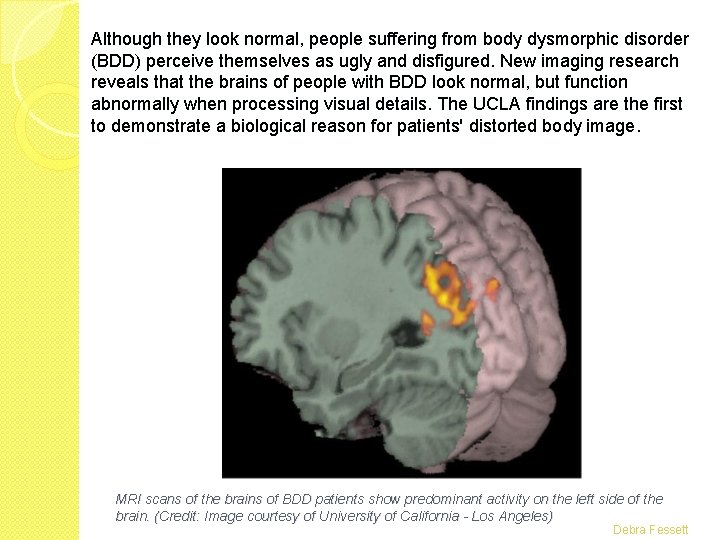 Although they look normal, people suffering from body dysmorphic disorder (BDD) perceive themselves as Although they look normal, people suffering from body dysmorphic disorder (BDD) perceive themselves as