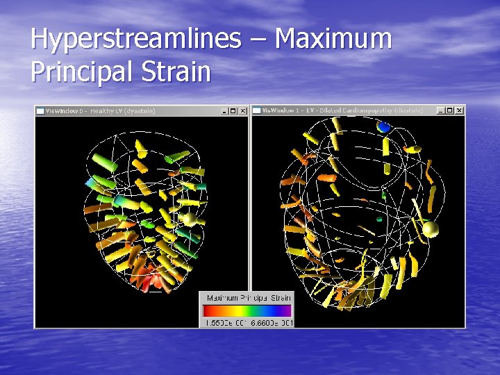 Hyperstreamlines – Maximum Principal Strain 