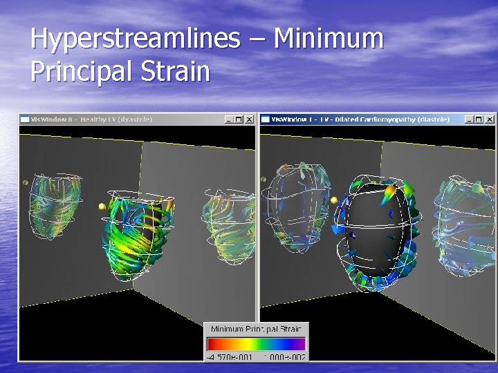 Hyperstreamlines – Minimum Principal Strain 