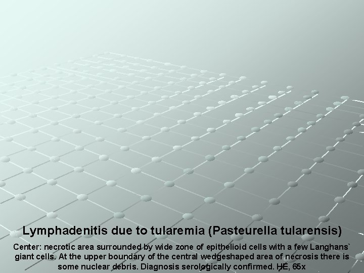 Lymphadenitis due to tularemia (Pasteurella tularensis) Center: necrotic area surrounded by wide zone of