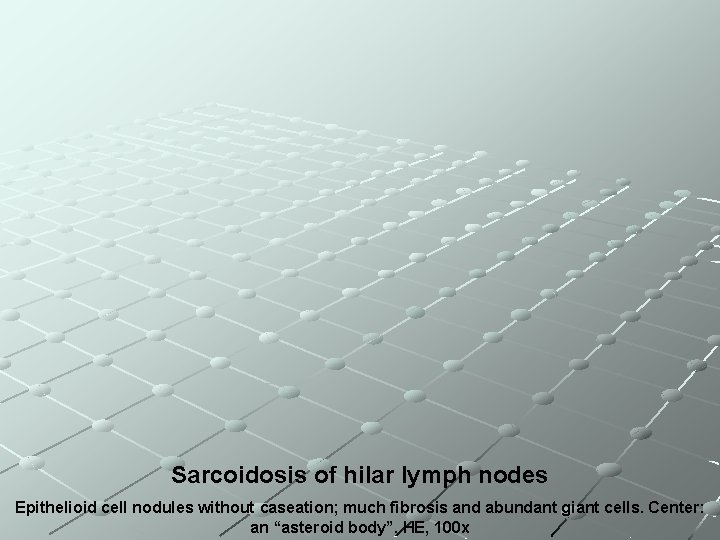 Sarcoidosis of hilar lymph nodes Epithelioid cell nodules without caseation; much fibrosis and abundant