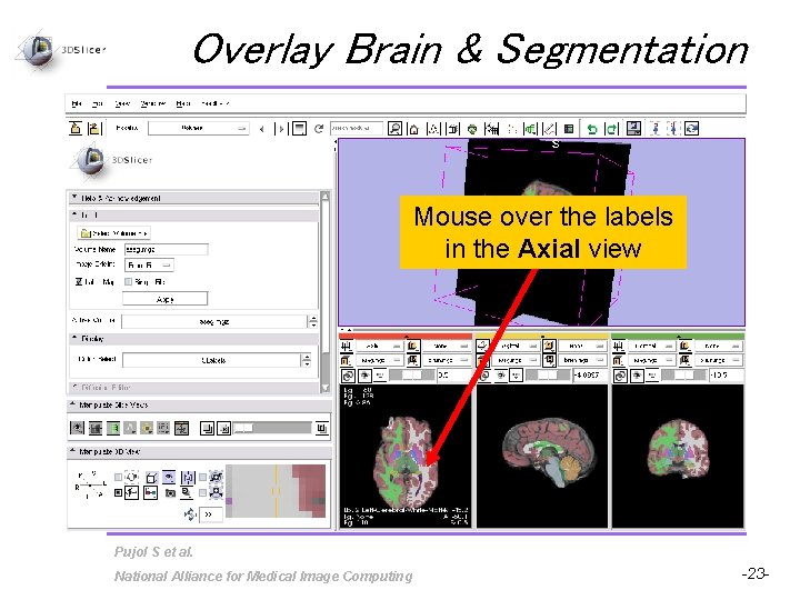 Overlay Brain & Segmentation Mouse over the labels in the Axial view Pujol S