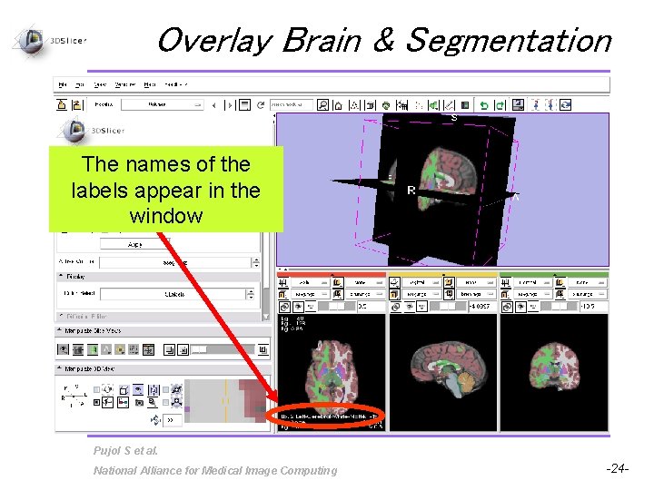 Overlay Brain & Segmentation The names of the labels appear in the window Pujol