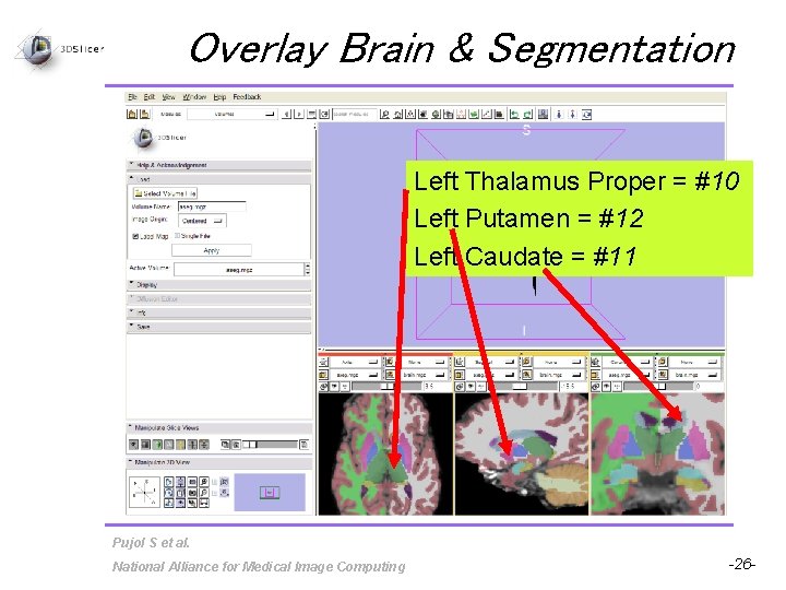 Overlay Brain & Segmentation Left Thalamus Proper = #10 Left Putamen = #12 Left