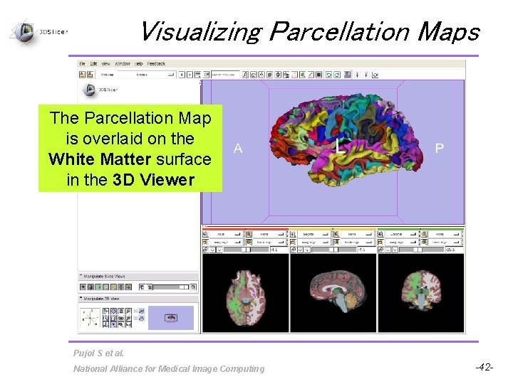 Visualizing Parcellation Maps The Parcellation Map is overlaid on the White Matter surface in