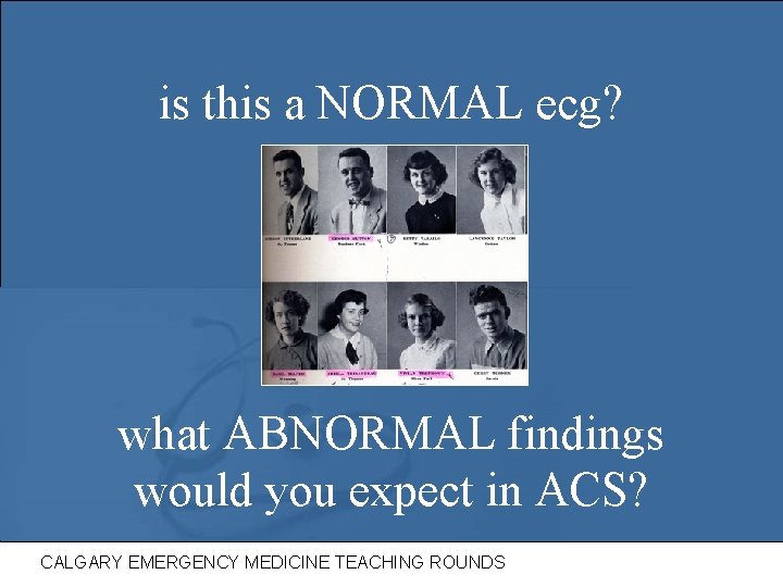 is this a NORMAL ecg? what ABNORMAL findings would you expect in ACS? CALGARY