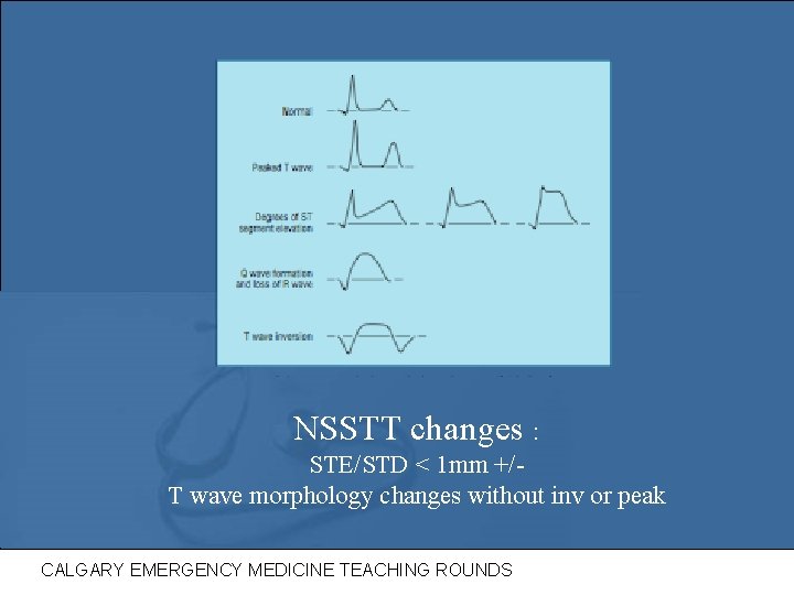 NSSTT changes : STE/STD < 1 mm +/T wave morphology changes without inv or