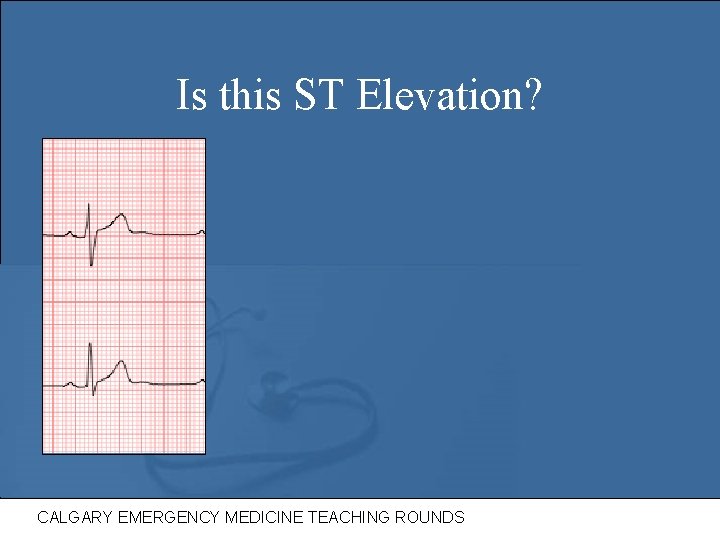 Is this ST Elevation? CALGARY EMERGENCY MEDICINE TEACHING ROUNDS 