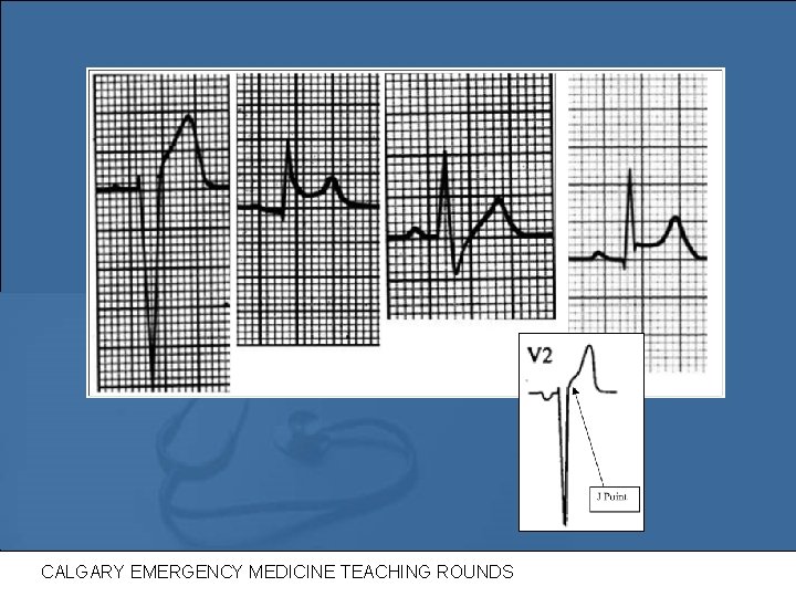 ST Elevation CALGARY EMERGENCY MEDICINE TEACHING ROUNDS 