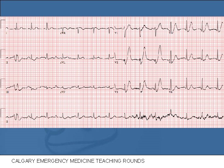 Ecg 1 CALGARY EMERGENCY MEDICINE TEACHING ROUNDS 