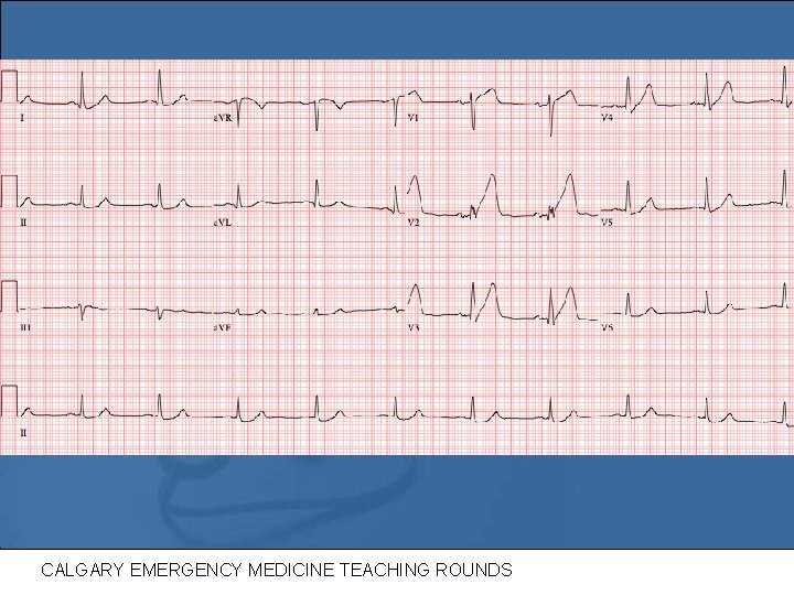 repeat Ecg 2 CALGARY EMERGENCY MEDICINE TEACHING ROUNDS 