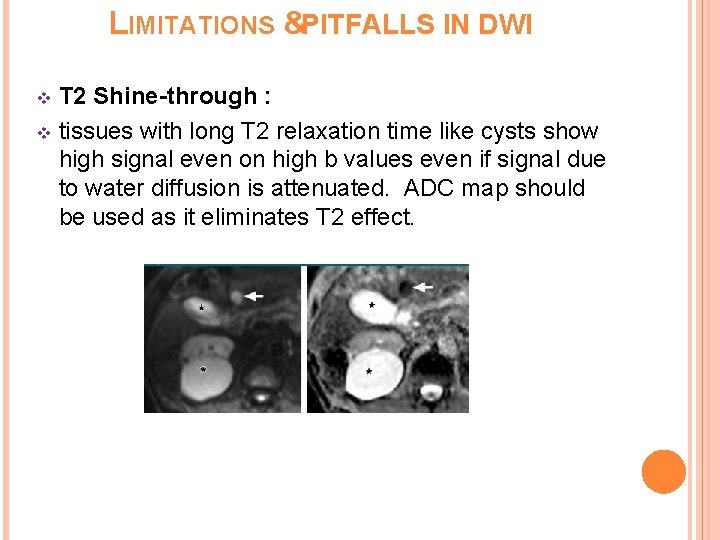 LIMITATIONS &PITFALLS IN DWI T 2 Shine-through : v tissues with long T 2