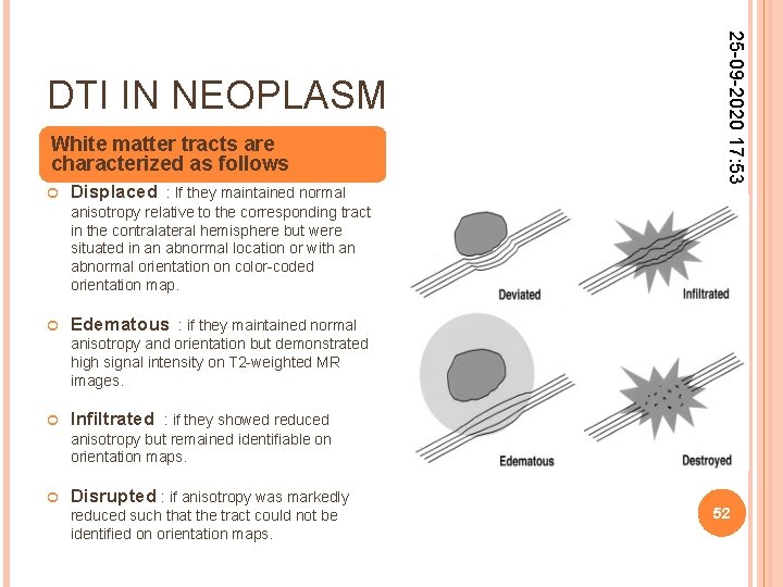 White matter tracts are characterized as follows Displaced : If they maintained normal 25