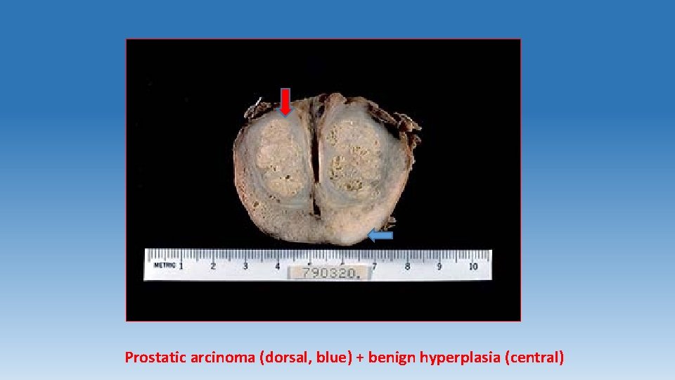 Prostatic arcinoma (dorsal, blue) + benign hyperplasia (central) 