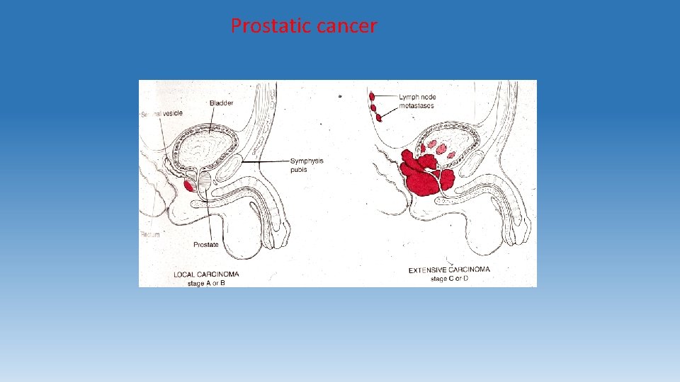 Prostatic cancer 