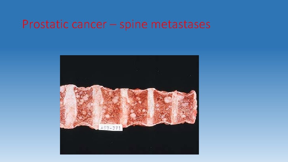 Prostatic cancer – spine metastases 