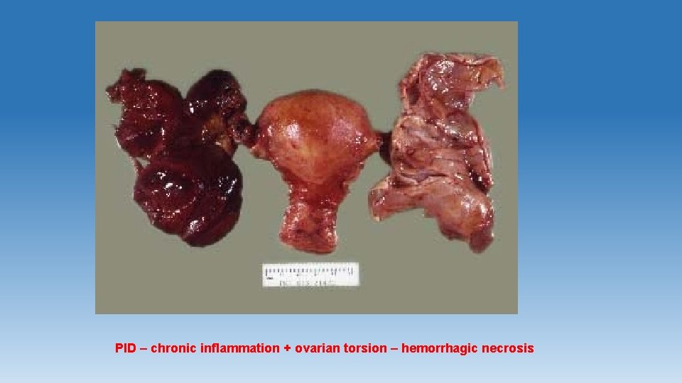 PID – chronic inflammation + ovarian torsion – hemorrhagic necrosis 