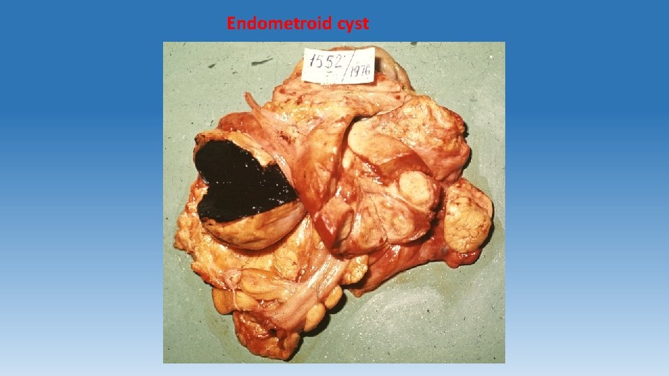 Endometroid cyst 