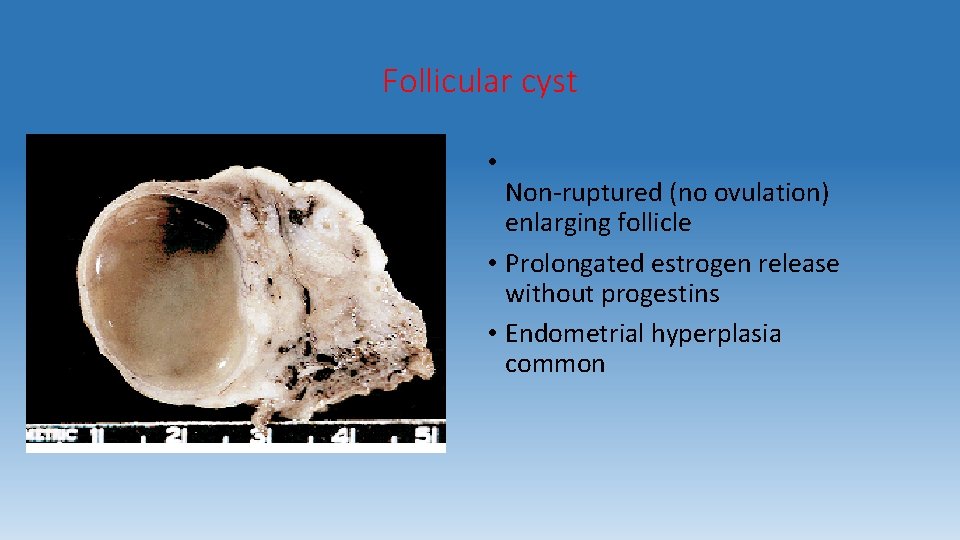 Follicular cyst • Non-ruptured (no ovulation) enlarging follicle • Prolongated estrogen release without progestins