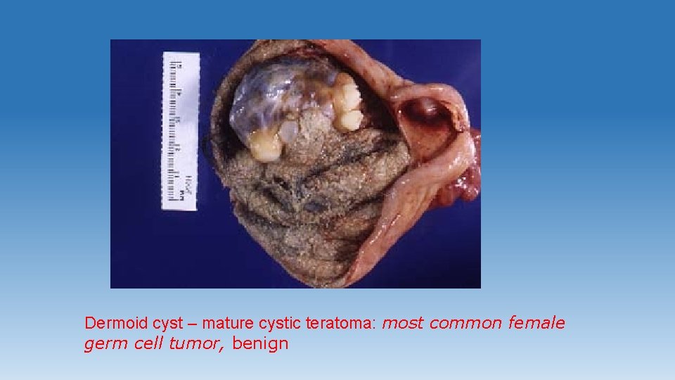 Dermoid cyst – mature cystic teratoma: most common female germ cell tumor, benign 